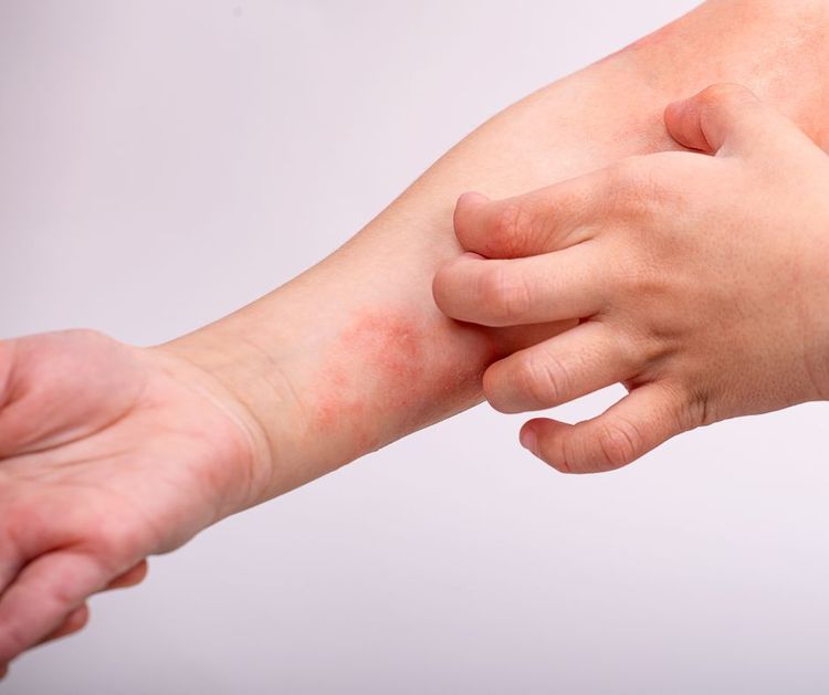 Foto: Kinderhand kratzt an einer geröteten, entzündeten Hautstelle am Unterarm