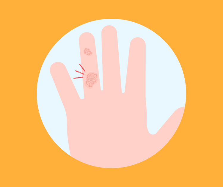 Illustration: Kinderhand mit zwei kleinen geröteten Knötchen am Finger vor orangem Hintergrund