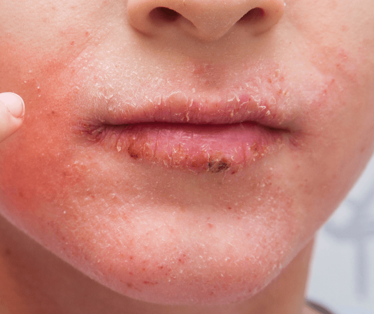 Lippenleckekzem: Warum immer im Winter